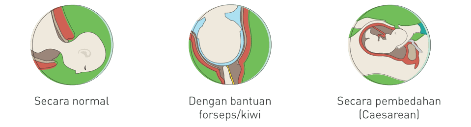 Illustrations of childbirth methods: normal, assisted, caesarean.